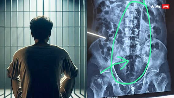 ਜੇਲ੍ਹ 'ਚ ਬੰਦ ਕੈਦੀ ਨੇ ਆਪਣੇ ਗੁਪਤ ਅੰਗ 'ਚ ਫਸਾ ਲਈ ਇੱਕ ਫੁੱਟ ਲੰਬੀ ਪਾਈਪ, ਡਾਕਟਰ X-Ray ਦੇਖ ਹੋ ਗਏ ਹੈਰਾਨ