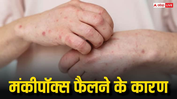 Can monkeypox be transmitted one person to other through kissing intimacy hugging क्या यौन संबंध बनाने से भी फैल सकता है मंकीपॉक्स वायरस? इसे लेकर रिपोर्ट में हुआ बड़ा खुलासा