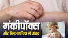 मंकीपॉक्स को चिकनपॉक्स समझने की न करें भूल, एक जैसे लक्षण फैला रहे हैं भ्रम