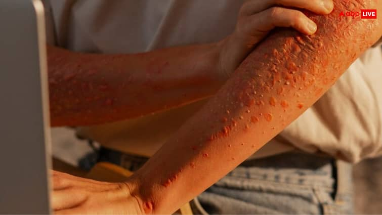 Skin Rash How to Know if Its Cancer or Just Normal Skin Rash: ​कहीं​ ये दाने कैंसर तो नहीं? इस तरीके से करें पहचान, खुद से भूलकर भी न करें ये काम