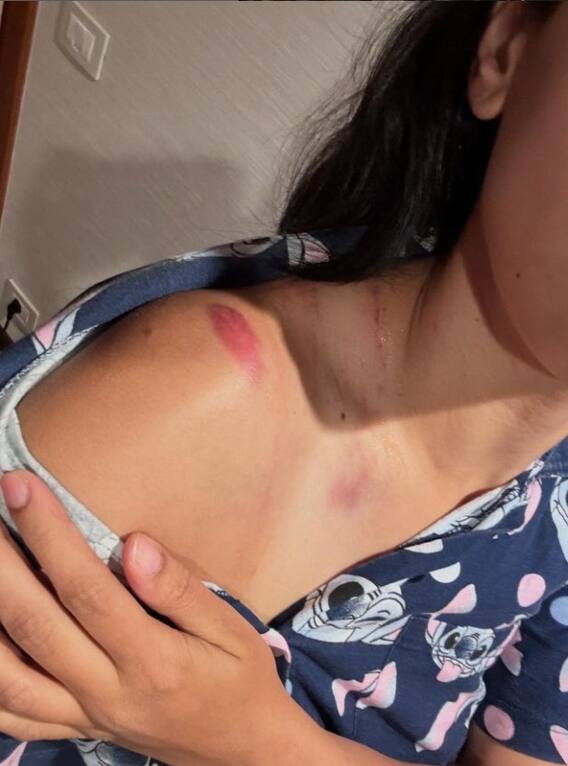 ਮਸ਼ਹੂਰ ਅਦਾਕਾਰਾ ਦੇ ਛਿੱਲੇ ਗਏ ਮੋਢੇ, ਗਰਦਨ 'ਤੇ ਲੱਗੀ ਡੂੰਘੀ ਸੱਟ