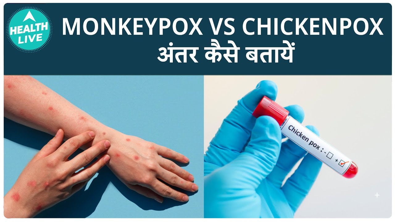 Monkeypox Or Chickenpox: Which Packs A Bigger Punch? Symptoms And Latest Updates | Health Live