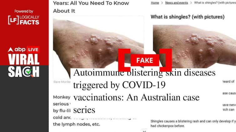 Mpox Is Not A Side Effect Of Covid-19 Vaccination Fact Check: Is Mpox A Side Effect Of Covid-19 Vaccination? Here's What Experts Say