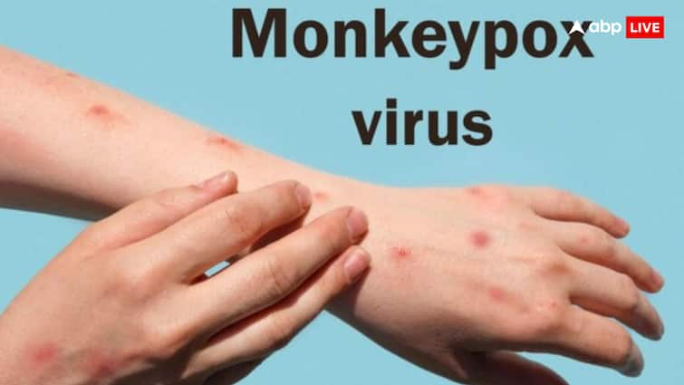 how monkeypox virus spreads know its symptoms and prevention Monkeypox: आखिर कैसे फैलता है मंकीपॉक्स, इस खतरनाक बीमारी से बचना है तो जानना जरूरी है ये बात