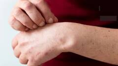 MonkeyPox Symptoms: આ સ્થિતિમાં મંકી પોક્સ બને છે જીવલેણ, રોગ દરમિયાન આ લક્ષણો વધે તો સાવધાન