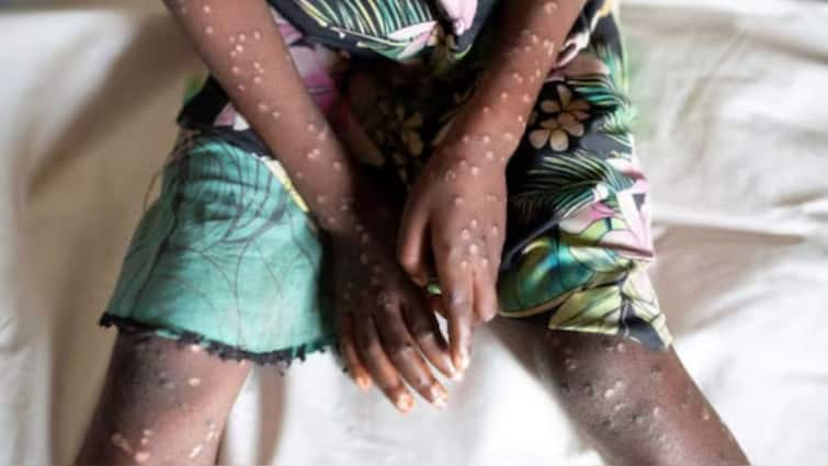 African Man Shares Horrifying Symptoms Of Mpox Virus Mpox Virus: నిద్ర పట్టడం లేదు, నొప్పితో నరకం చూస్తున్నా - ఎమ్‌పాక్స్ సోకిన బాధితుడి ఆవేదన