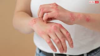 Psoriasis: पुरुषों में सोरायसिस होने की संभावना महिलाओं की तुलना में दोगुनी होती है, जानें इसके लक्षण