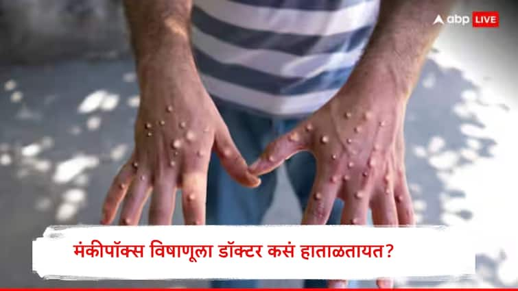 Monkeypox Doctor Handling the Monkeypox virus WHO declared Next Pandamic what is treatement for Monkeypox monkeypox:  मंकीपॉक्सच्या रुग्णांना डॉक्टर सध्या कसं हाताळतायत? रोगी माणसाच्या त्वचेशी संपर्क आला तर...