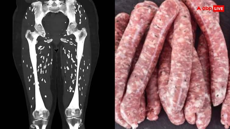 Doctors got scared after seeing the CT scan of a person who ate undercooked pig meat अधपके सुअर का मांस खाने वाले शख्स का CT स्कैन देख डॉक्टर भी हैरान, पैरों में दिखी ये चीज