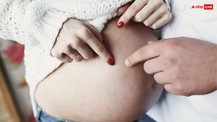 To avoid stretch marks in pregnancy, follow these five measures from the third month itself