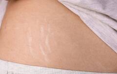 શું તમે પણ સ્ટ્રેચ માર્ક્સની સમસ્યાનો સામનો કરો છો,  આ રીતે મેળવો છૂટકારો  