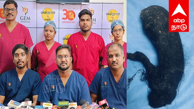 Puducherry Doctors successfully removed 1.5 kg hair from young woman stomach - TNN Puducherry: சிறுமியின் வயிற்றில் 1.5 கிலோ தலை முடி... வெற்றிகரமாக அகற்றிய மருத்துவர்கள் சொன்ன அதிர்ச்சி தகவல்
