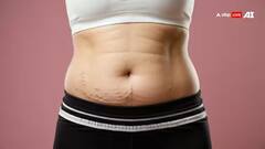 Stretch Marks Remedies: પ્રેગ્નન્સી દરમિયાન આ ટિપ્સ કરો ફોલો, ક્યારેય નહિ આવે સ્ટ્રેચ માર્ક