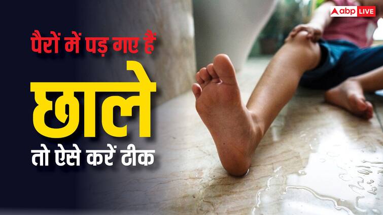 5 effective remedies to alleviate common foot problems from pain relief to improved foot health नई फुटवियर के कारण पैरों में पड़ गए हैं छाले तो इन तरीकों से करें ठीक, 2 दिन में मिलेगा आराम