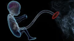 Andhra Woman With Severe Abdominal Pain Found To Have 24-Wk-Old Rare 'Stone Baby' Inside