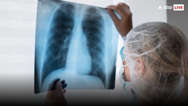 Union Health Ministry approves tuberculosis new treatment which small but more powerful TB: अब नए तरीके से होगा टीबी का इलाज, केंद्र सरकार ने छोटे और असरदार ट्रीटमेंट को दी मंजूरी