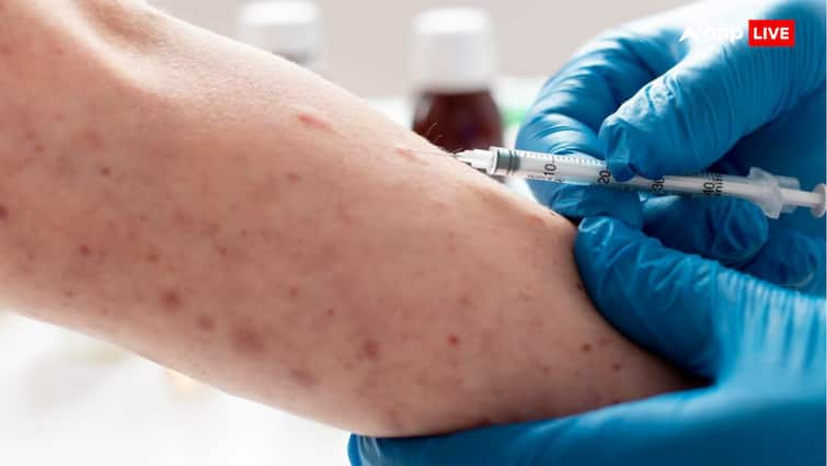 Monkeypox enters India first suspected patient found, isolated in hospital Monkeypox: दुनिया भर में कहर मचा रहे मंकीपॉक्स की भारत में दस्तक, मिला पहला संदिग्ध मरीज़, अस्पताल में किया गया Isolate