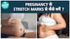 Simple Methods To Remove Stretch Marks: Effective Solutions Revealed | Health Live