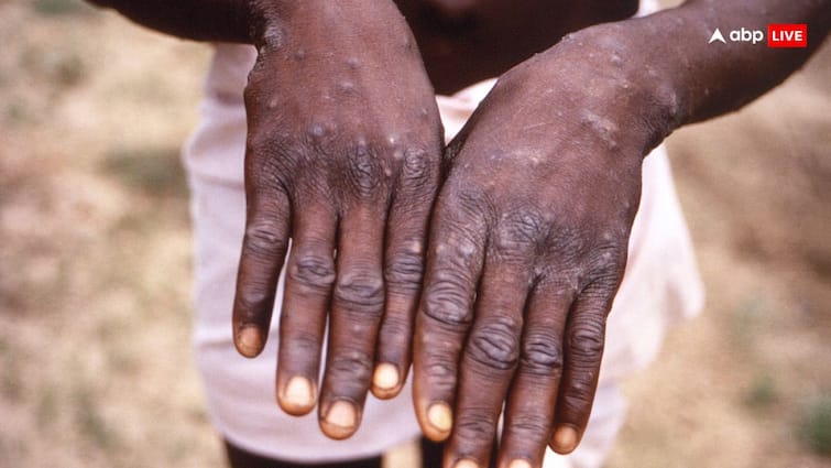 Monkeypox enters India Suspected Mpox case under investigation patient put under isolation no cause for alarm भारत में भी मंकीपॉक्स की एंट्री! विदेश से लौटे शख्स में मिले लक्षण, आइसोलेट किया गया