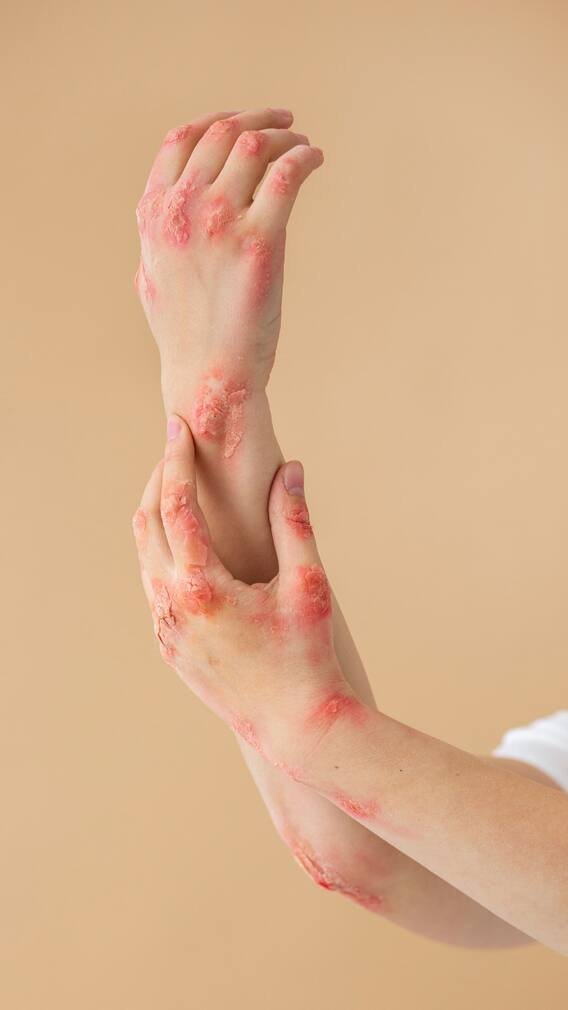 कितने देशों में आए हैं मंकीपॉक्स के मामले ?