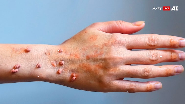 Does monkeypox virus also spread through the air? Know how different this disease is from Corona