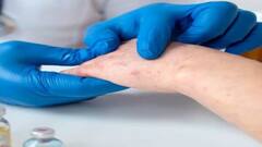 MonkeyPox ને લઇને સ્વાસ્થ્ય મંત્રાલયે જણાવ્યું શું કરવું અને શું ના કરવું, જાણો તમારા ફાયદાની વાત