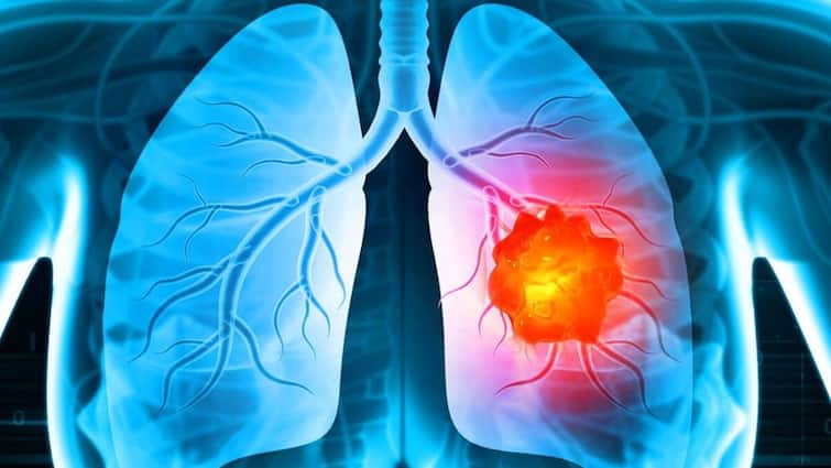 short-of-breath-symptoms-can-it-be-lung-cancer-know-what-the-experts-say-about-it Lung Cancer: ਲਗਾਤਾਰ ਸਾਹ ਚੜ੍ਹਦਾ ਹੈ ਤਾਂ ਸਮਝ ਲਓ ਹੋ ਗਿਆ ਫੇਫੜਿਆਂ ਦਾ ਕੈਂਸਰ? ਜਾਣੋ ਕੀ ਕਹਿੰਦੇ ਹਨ ਮਾਹਿਰ