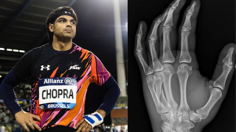 diamond league 2024 silver medalist neeraj chopra played with a broken arm Neeraj Chopra: இறுதிப்போட்டிக்கு முன்பே எலும்பு முறிவு - வெள்ளிப்பதக்கம் மூலம் நாட்டிற்கு பெருமை சேர்த்த நீரஜ் சோப்ரா