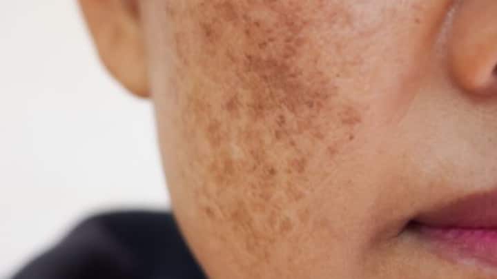 4. Don’t Stress Over Blemishes, Tackle Them Gently: Blemishes are normal, especially during the festive season! To manage them without irritation, opt for products with gentle ingredients like Tea Tree and Salicylic Acid, which help balance the skin, reduce inflammation, and promote clarity without drying it out. And don’t forget, your skin’s natural cell regeneration peaks while you sleep, so aim for 6-8 hours of rest to support clear, healthy skin. It's all about balance! (Image Source: Pinterest/SkinRenewalSA)