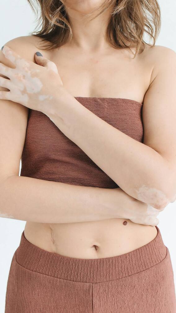 हाथ में सफेद दाग इस बीमारी के हैं संकेत