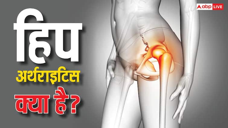 What is hip arthritis? How is it different from arthritis and where does the pain start in the body?