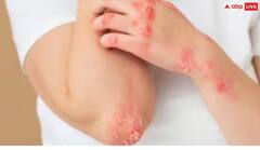 Eczema: ખરજવુંના દર્દીઓએ આ રીતે મેથીનો ઉપયોગ કરવો જોઈએ, અઠવાડિયામાં જ દેખાશે ફાયદો