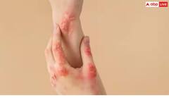 Eczema: ખરજવુંના દર્દીઓએ આ રીતે મેથીનો ઉપયોગ કરવો જોઈએ, અઠવાડિયામાં જ દેખાશે ફાયદો
