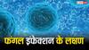 मौत का दूसरा नाम बना फंगल इंफेक्शन, जानें कैसे फैलता है ये और क्या होते हैं लक्षण