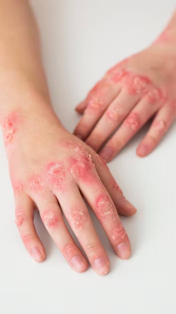 कितने लोगों की जान ले चुका है फंगल इंफेक्शन