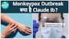 First Case of Clade 1B Mpox Detected in India, 38-Year-Old Man from Kerala Returns from UAE