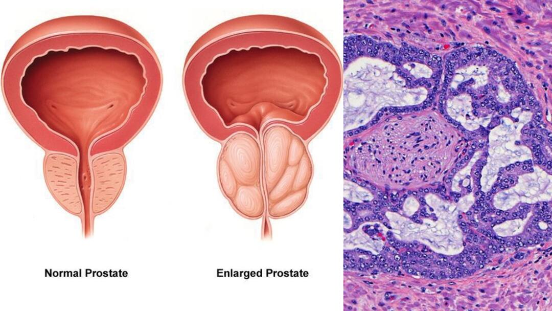 prostate cancer cases rising among men aged below 50 in India Prostate cancer: మగవారిలో పెరుగుతున్న ప్రొస్టేట్ క్యాన్సర్‌ ముప్పు - 50 ఏళ్లలోపు వారే ఎక్కువ బాధితులు