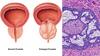 Prostate cancer: మగవారిలో పెరుగుతున్న ప్రొస్టేట్ క్యాన్సర్‌  ముప్పు - 50 ఏళ్లలోపు వారే ఎక్కువ బాధితులు