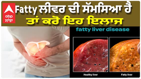 Fatty liver disease: ਮੋਟਾਪਾ, ਸ਼ੂਗਰ, ਪਾਚਕ ਵਿਕਾਰ ਨੂੰ ਰੋਕਣ ਲਈ ਤੁਹਾਨੂੰ ਇਹ ਜਾਣਨ ਦੀ ਜ਼ਰੂਰਤ ਹੈ..