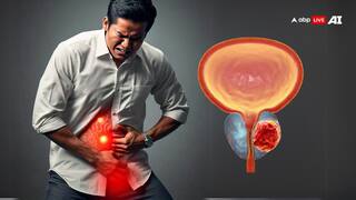 Prostate Cancer: Know About Risk Factors, Early Detections, Treatments And More