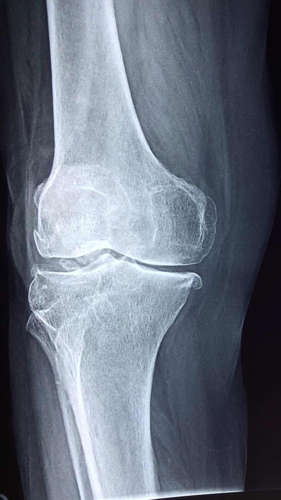 எலும்புகளை வலுவாக வைத்திருக்க இந்த உணவுகளை சேர்த்துக் கொள்ளுங்கள்