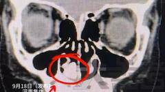 दो साल से बदबू की शिकायत कर रहे बच्चे की नाक में फंसा था कुछ ऐसा, एक्स-रे देख उड़े डॉक्टर के होश