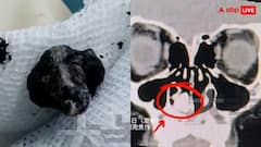 दो साल से बदबू की शिकायत कर रहे बच्चे की नाक में फंसा था कुछ ऐसा, एक्स-रे देख उड़े डॉक्टर के होश