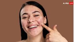 क्या पिंपल्स से छुटकारा दिला सकती है रोजाना लहसुन की एक कली, जान लें क्या कहते हें एक्सपर्ट्स