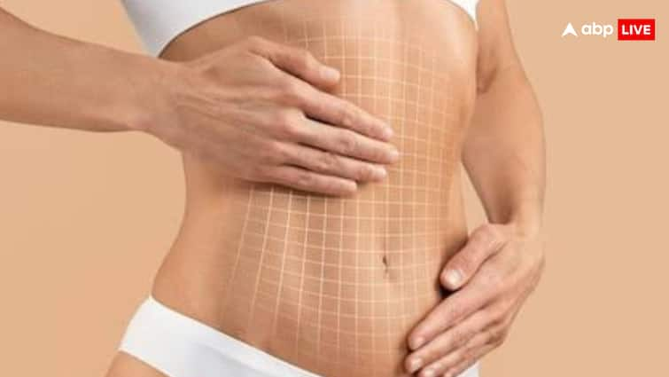 Is it right to undergo liposuction for weight loss, know the risks and side effects