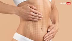 क्या वेटलॉस के लिए लिपोसक्शन कराना सही है, जानिए रिस्क और साइड इफेक्ट्स