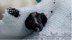 બે વર્ષથી દુર્ગંધની ફરિયાદ કરી રહેલા બાળકના નાકમાં કંઈક ફસાઈ ગયું, એક્સ-રે જોઈને ડોક્ટર પણ ચોંકી ગયા