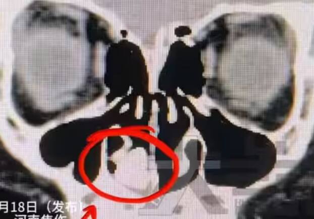 ਚੀਨ ਦੇ ਹੇਨਾਨ ਰਾਜ ਦੇ ਜਿਆਓਜ਼ੂਓ ਦਾ ਇੱਕ 7 ਸਾਲਾ ਲੜਕਾ ਆਪਣੇ ਮਾਤਾ-ਪਿਤਾ ਨੂੰ ਦੱਸ ਰਿਹਾ ਸੀ ਕਿ ਉਸ ਨੂੰ ਘੱਟੋ-ਘੱਟ ਦੋ ਸਾਲਾਂ ਤੋਂ ਕਿਸੇ ਚੀਜ਼ ਦੀ ਬਦਬੂ ਆ ਰਹੀ ਸੀ, ਪਰ ਉਹ ਕਦੇ ਸਮਝ ਨਹੀਂ ਆਈ ਕਿ ਹੈ ਕੀ ਚੀਜ਼।