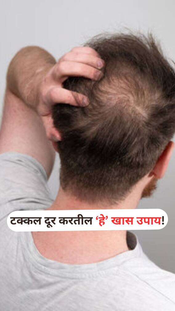 डोक्यावरचं टक्कल कमी करण्यासाठी 'हा' खास उपाय!