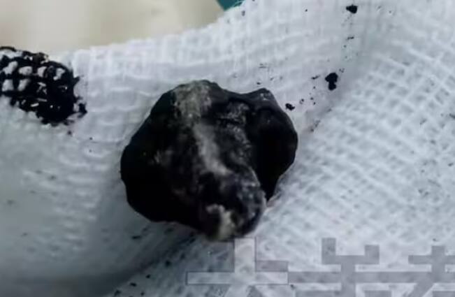 ਹਸਪਤਾਲ ਦੇ ਬੁਲਾਰੇ ਨੇ 'ਐਲੀਫੈਂਟ ਨਿਊਜ਼' ਨੂੰ ਦੱਸਿਆ ਕਿ ਬੱਚੇ ਦੇ ਨੱਕ 'ਚ ਪੇਚ ਕਾਫੀ ਸਮੇਂ ਤੋਂ ਫਸਿਆ ਹੋਇਆ ਸੀ, ਇਸ ਲਈ ਉਸ 'ਤੇ ਪਰਤਾਂ ਜਮ੍ਹਾ ਹੋ ਗਈਆਂ ਸਨ। ਨੱਕ ਦੀ ਸਫਾਈ ਕਰਨ ਤੋਂ ਬਾਅਦ ਪਤਾ ਲੱਗਾ ਕਿ ਇਹ ਲੋਹੇ ਦਾ ਪੇਚ ਸੀ।